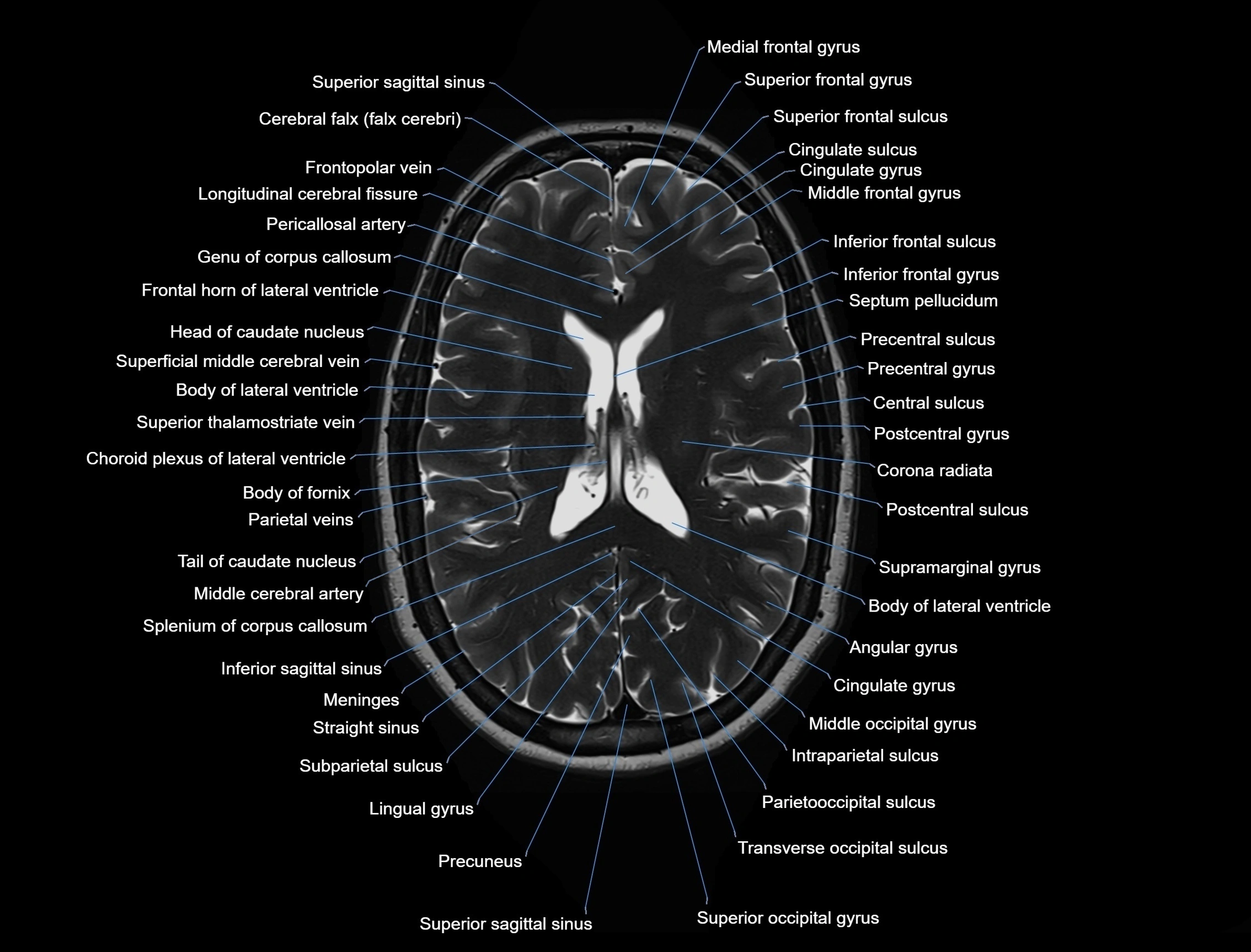 MRI Brain axial cross sectional radiology anatomy 3T image  -img-00001-00034.webp